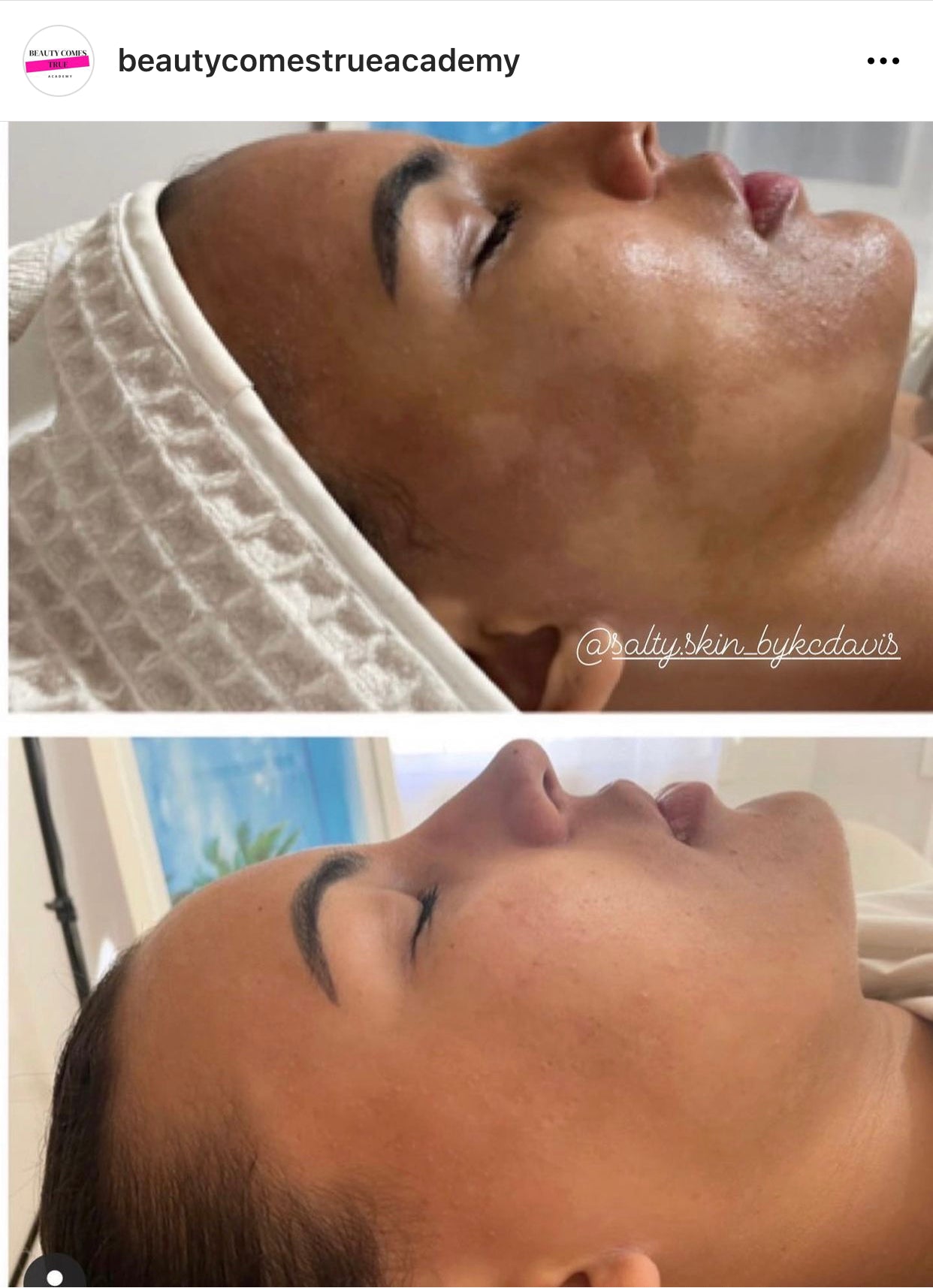 Microneedling course with Kit