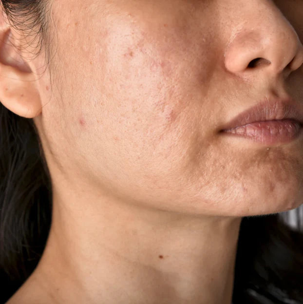 Acne scars