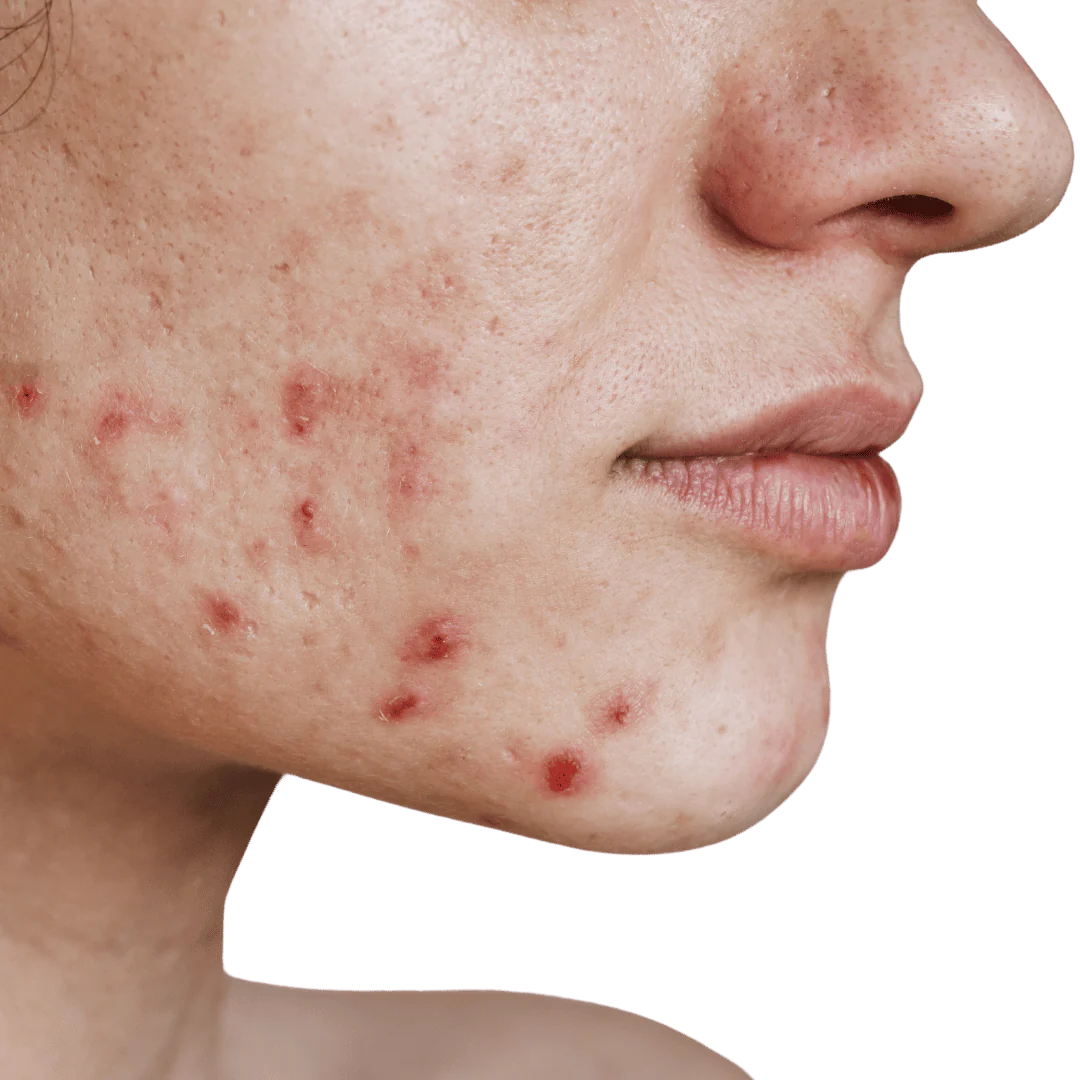 Acne