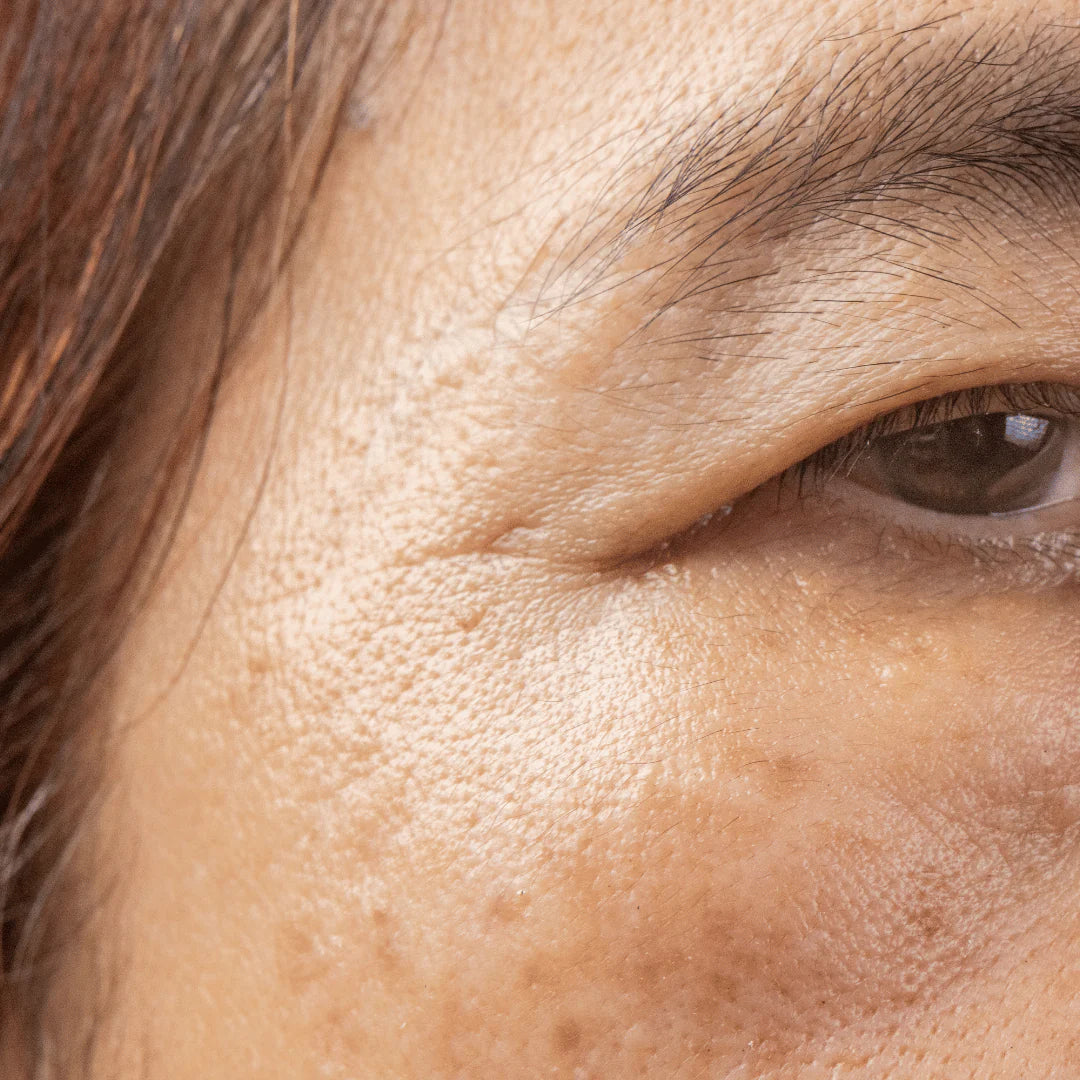 Age spots