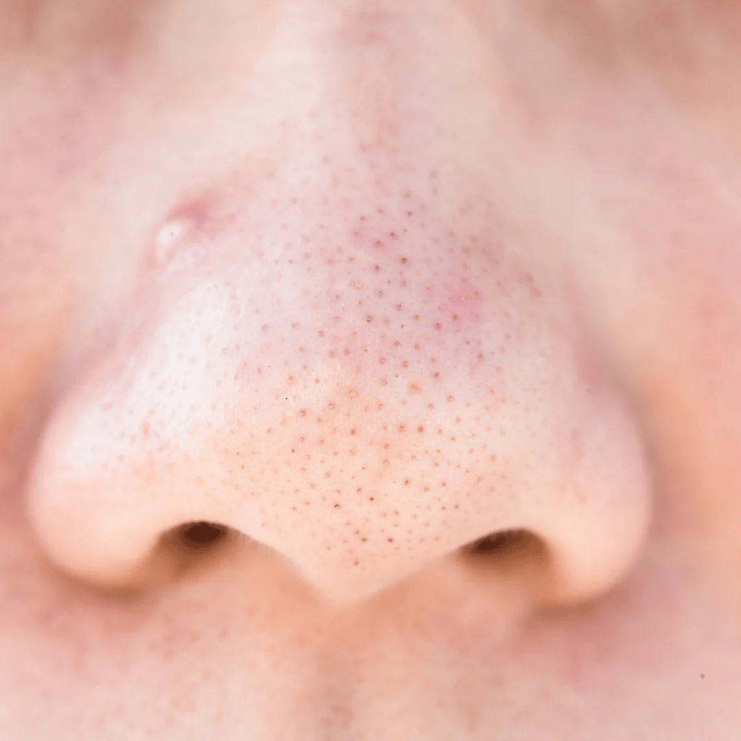 Blackheads