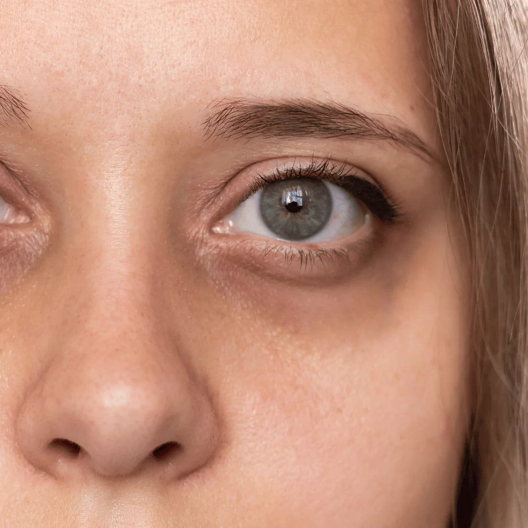 Dark circles