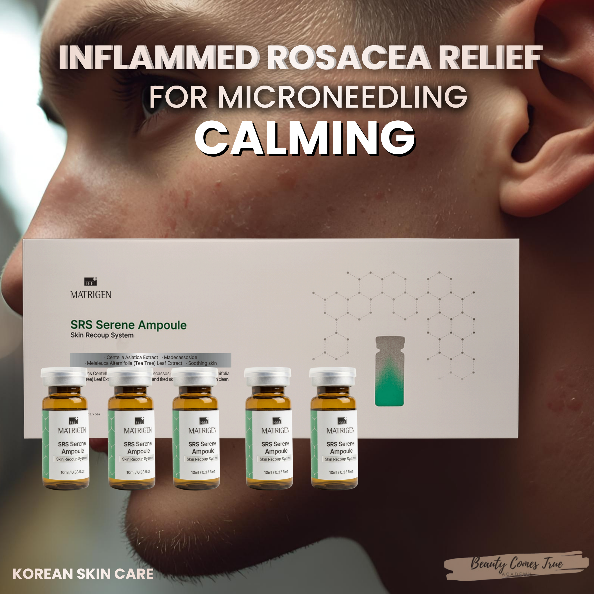 Calming serum srs 10ml x 5 bottles (For Acne & Rosacea)