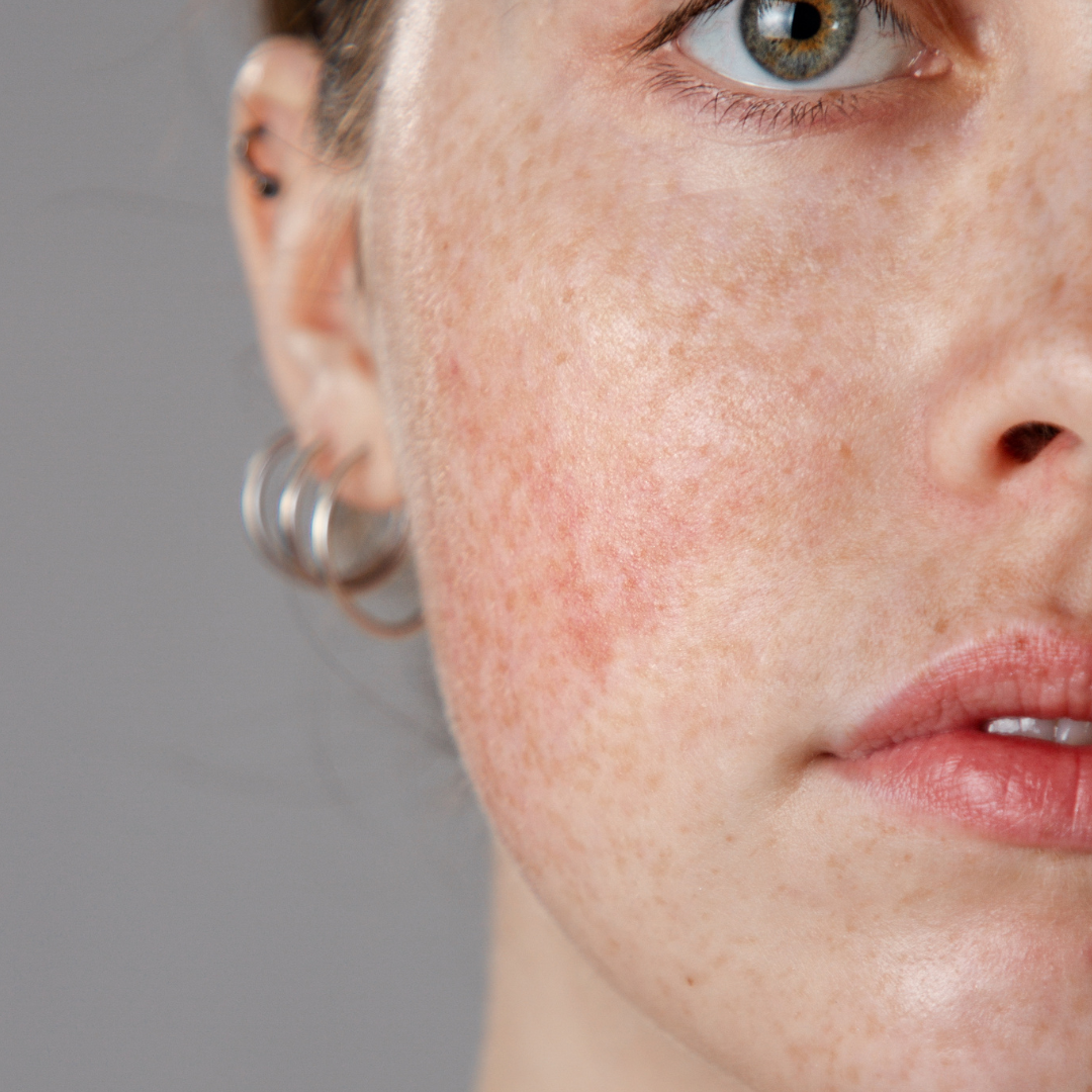 Rosacea