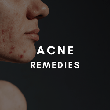 Acne remedies