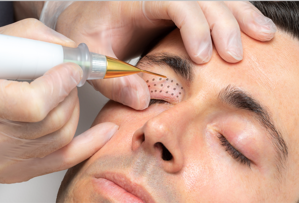 Fibroblast course online (no device) - Beauty Comes True Academy