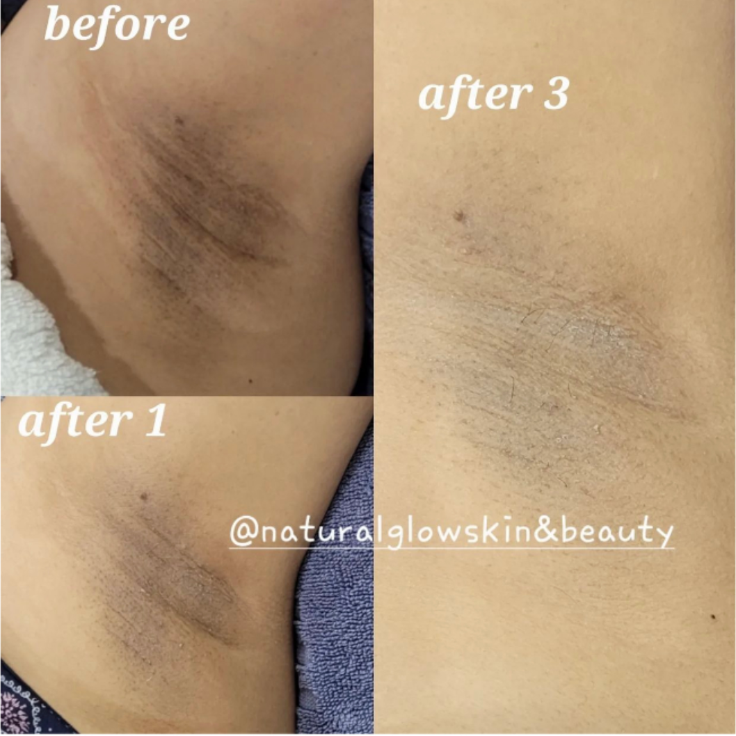 Intimate whitening course