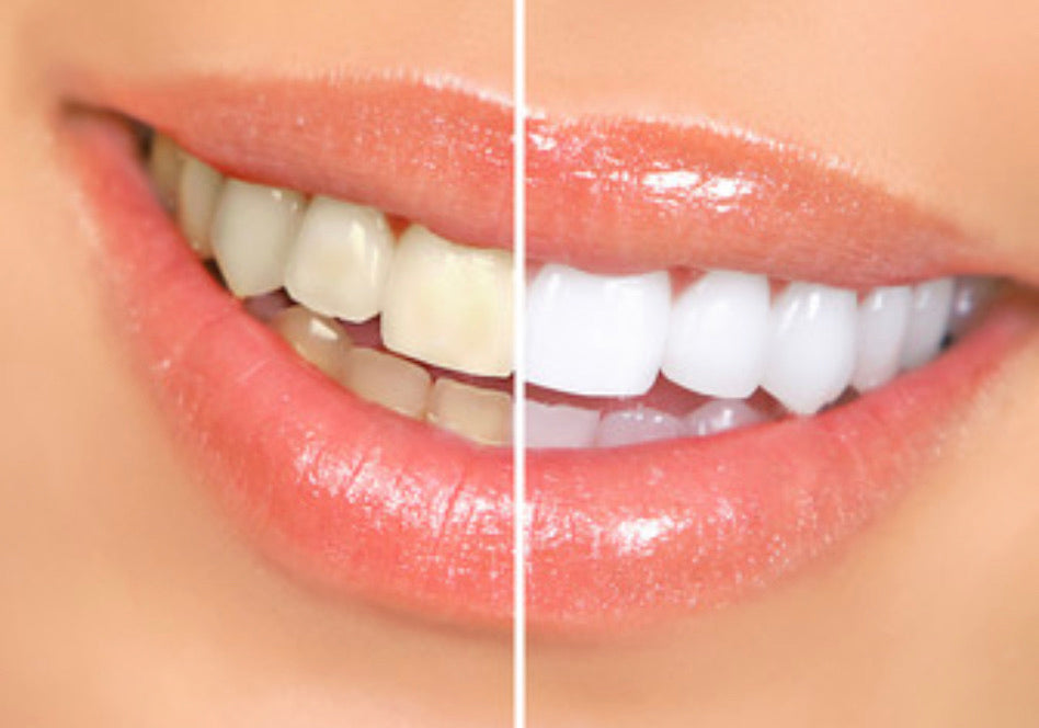 Teeth whitening - Beauty Comes True Academy